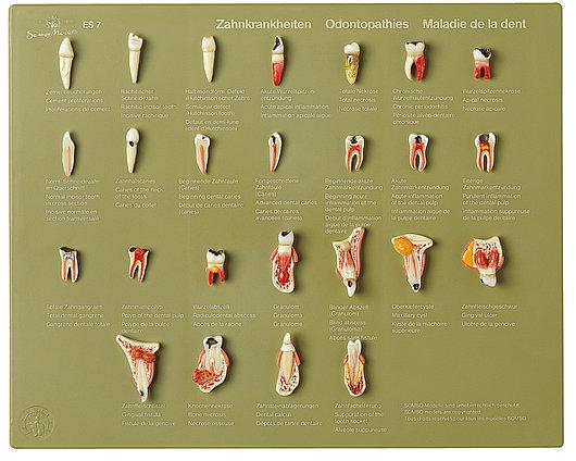 ES7-1 Zuby a čelist - Somso Modelle: Sada zubů „Odontopatie