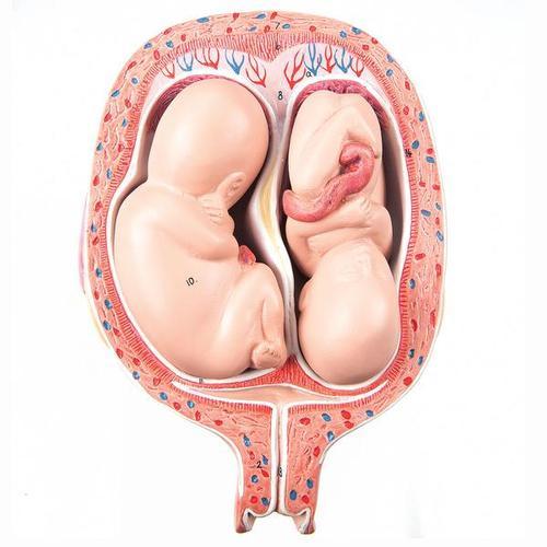 L10-7-1 Těhotenství, porod - ostatní: Plod dvojčat 5. měsíc