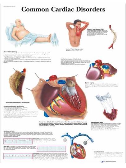 Výstřižek8779 Anatomické obrazy: Obraz - srdeční poruchy