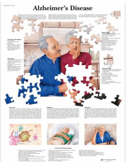 Výstřižek9943 Anatomické obrazy: Obraz - Alzheimerova choroba