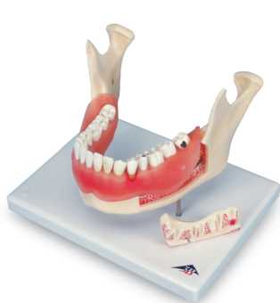 01-81-559 Zuby a čelist: Model dentálních onemocnění, 2x zvětšený, 21 dílů
