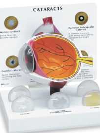 01-81-668 Oko : Model oka se šedým zákalem