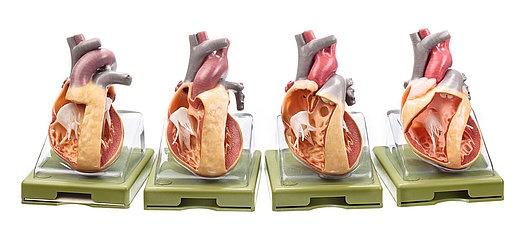 OS7-1 Srdce, oběhový systém - Somso Modelle: Sada modelů vrozených chorob srdce