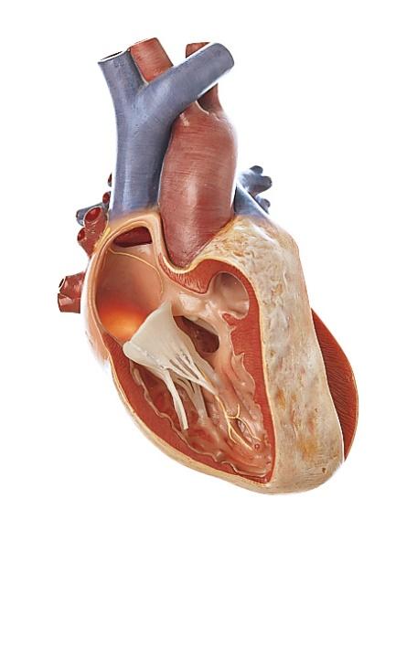 OS7-2-12 Srdce, oběhový systém - Somso Modelle: Fallotova tetralogie