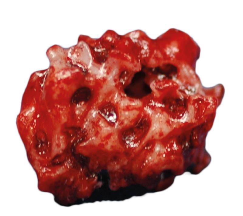 R16511-10-1 Ultrazvukové, CT modely: Simulační sada uzlin Subsolid Nodules 3D GGO
