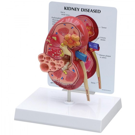 1019550_01_1200_1200_Diseased-Kidney-Model