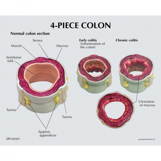 1019555_03_1200_1200_4-Piece-Colon-with-Pathologies