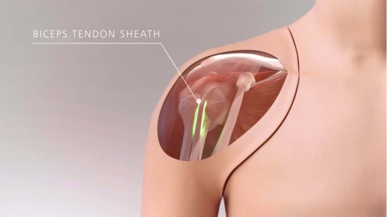 70202_ultrasound_shoulder_img_web_07