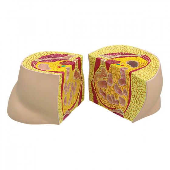 W33363_02_1200_1200_Obesity-Model