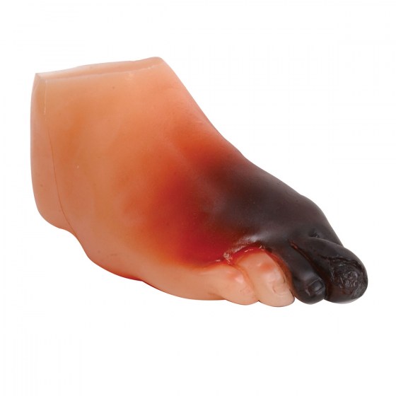 W43107A_01_1200_1200_Severe-Diabetic-Foot-Model